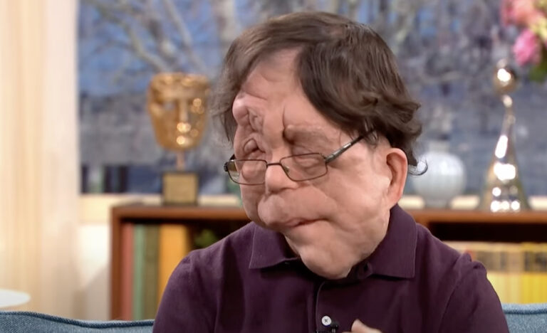 Meet Adam Pearson Who Plays the Role of Oswald in Thriller Film ‘A Different Man’